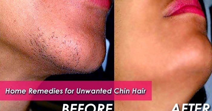 How To Get Rid Of Female Chin Hair Urdu Tips Entertainment