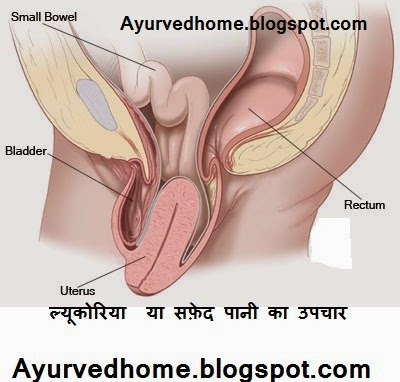 Safed Paani Treatment and symptoms  ल्यूकोरिया या सफ़ेद पानी का उपचार  Safed Paani Ka Ayurvedic Upchaar for Female