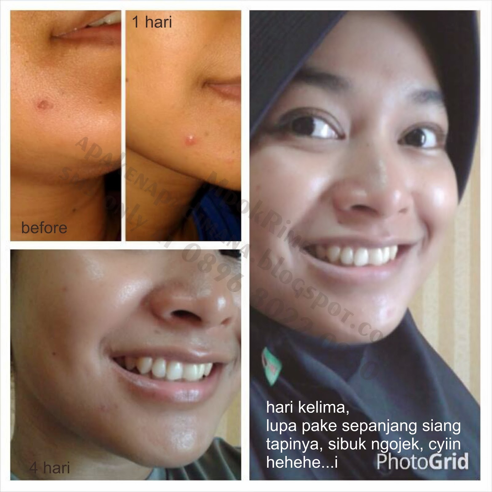 Apa Kenapa Dimana?: Sebelum dan Sesudah Pakai Nano Spray MCI, In My