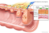 Estadíos cáncer de colon