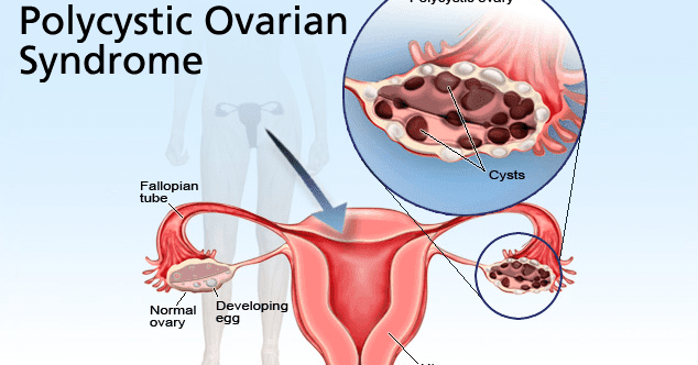 PCOD and Infertility
