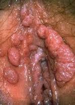Obat Kondiloma Akuminatum Obat Kondiloma Akuminatum