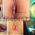 Obat Wasir Stadium 4 Tanpa Operasi thumbnail