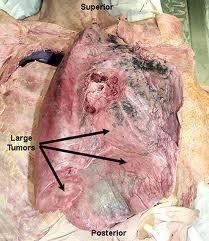 Asbestosis Is The Scarring Of Lung Tissue Around Terminal Bronchioles And Alveolar Ducts Resulting From The Inhalation Of Asbestos Fibers Asbestosis Is The Scarring Of Lung Tissue Around Terminal Bronchioles And Alveolar Ducts Resulting From The Inhalation Of Asbestos Fibers