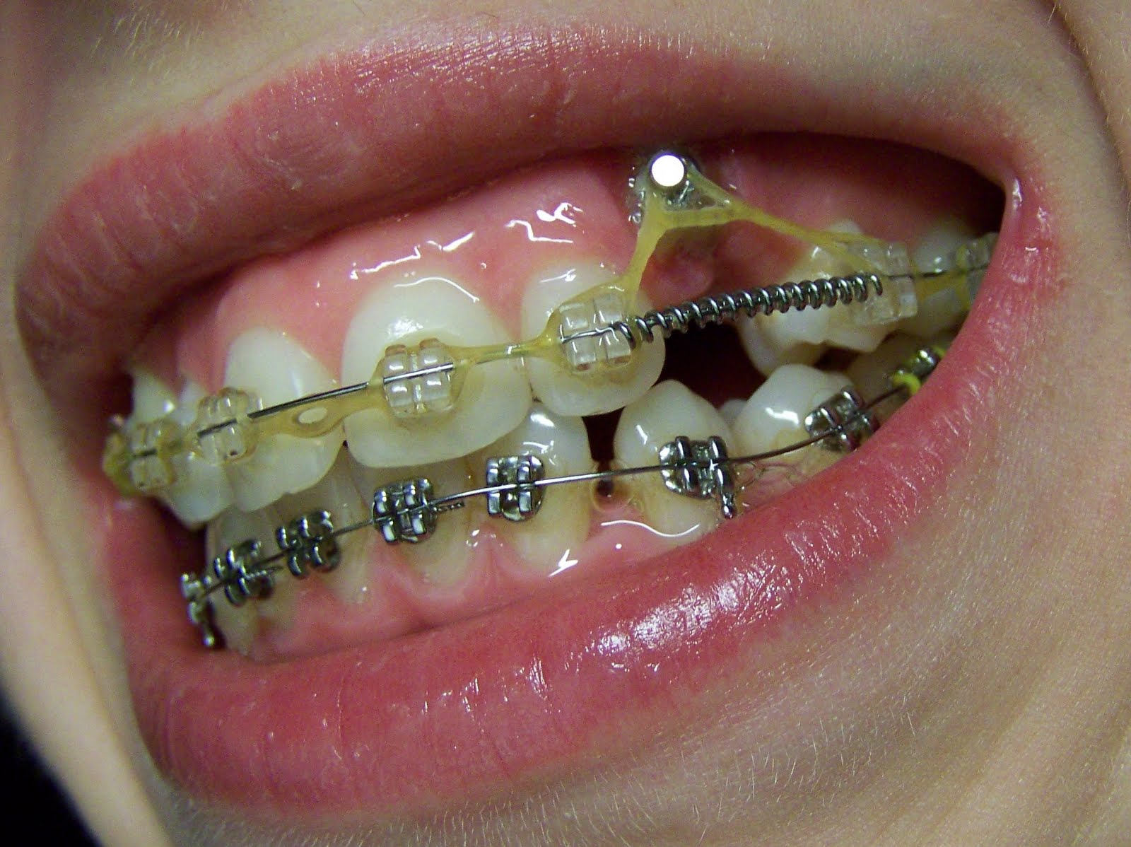 Брекеты. Как с ними жить? После 78 месяцев ношения