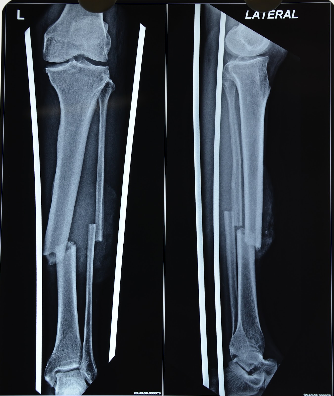 GRADE III B FRACTURE TIBIA MIDDLE 1/3RD FREE ALT COVERAGE CRUSH