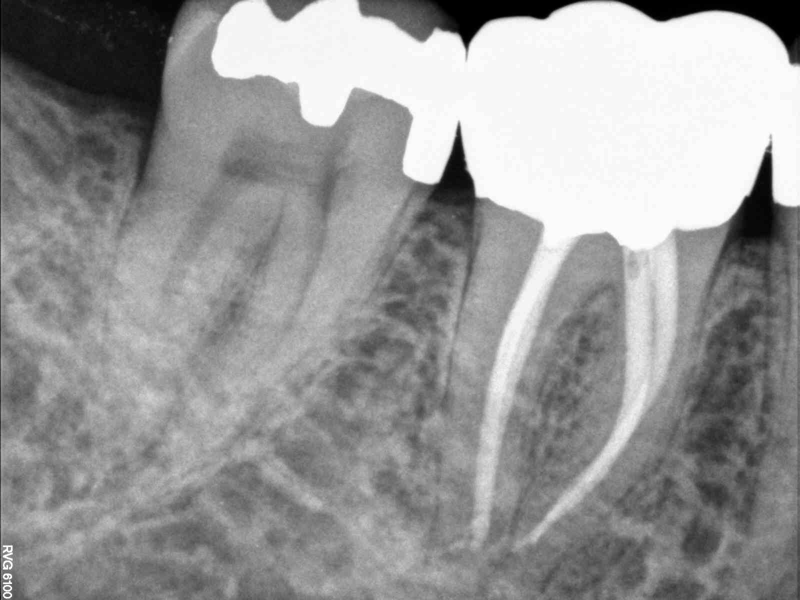 molar root canal molar root canal