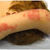 Gejala Herpes Pada Anak Anak thumbnail