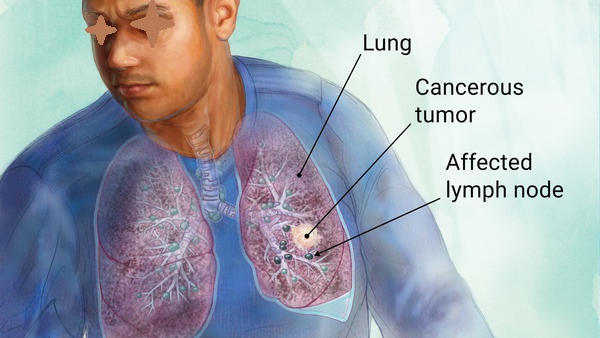 Salah satu pemicu kanker paru-paru adalah