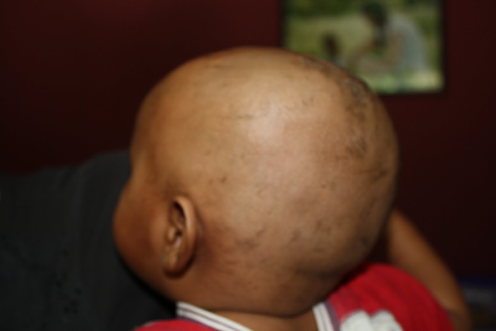 . Lice + Scalp Fungal Infection = Bald