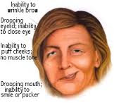 BELL'S PALSY