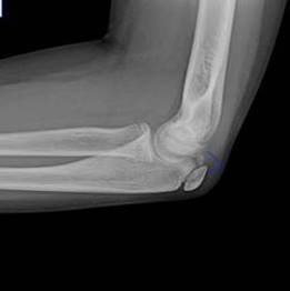 olecranon fracture olecranon fracture