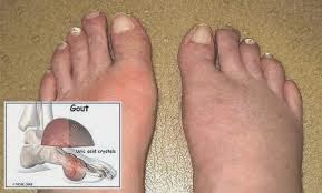 cay no ngay dat benh gout