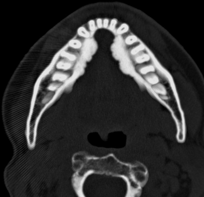 Torus Mandibularis Ct