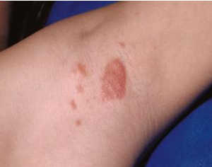 Psoriasis inversa Psoriasis inversa