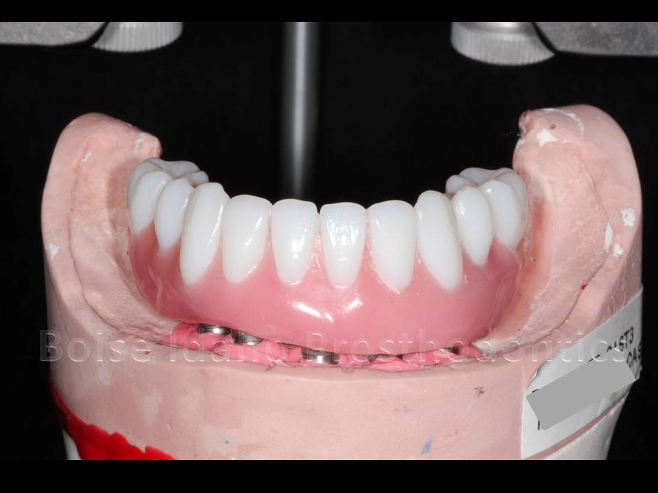 Boise Idaho Prosthodontics Mandibular Hybrid Prosthesis Denture Tooth