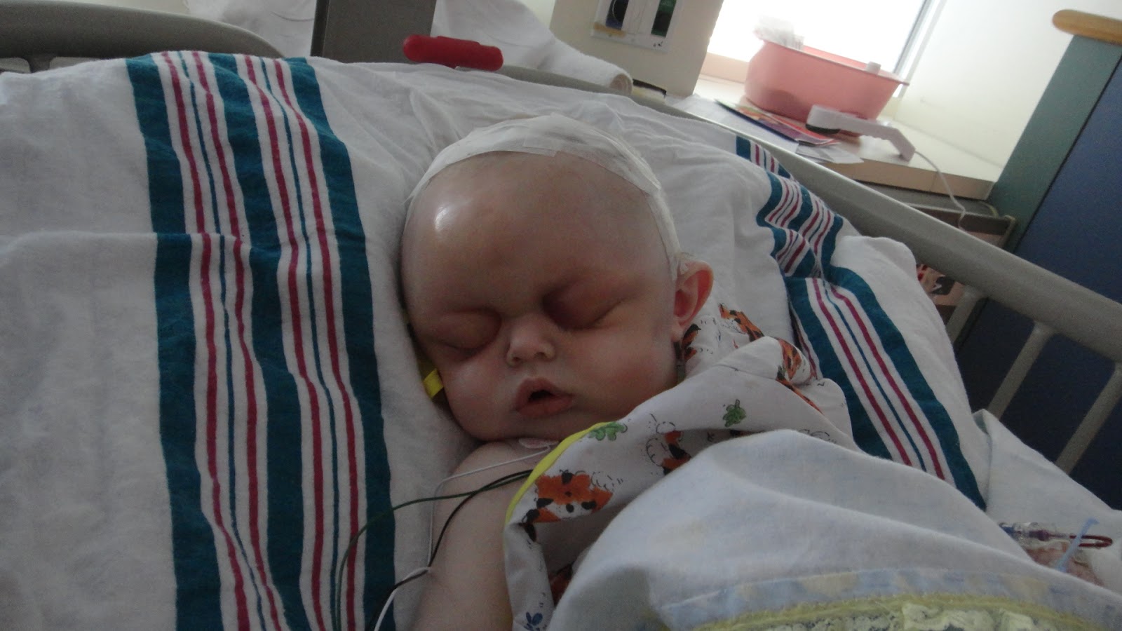 FATTKAW: Metopic Ridge and it is gone...