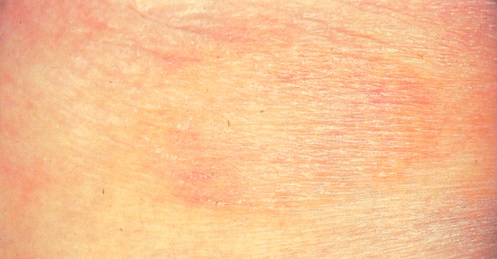 Los tratamientos de la psoriasis por la agua oxigenada