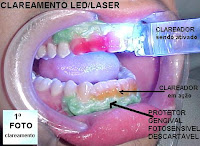 CLAREAMENTO DENTÁRIO