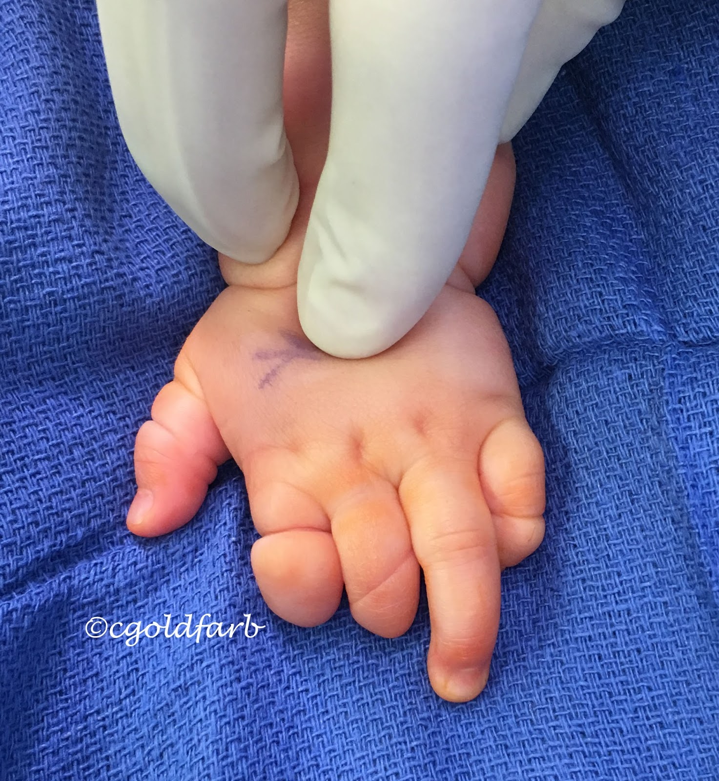 More on Amniotic Constriction Band Congenital Hand and Arm