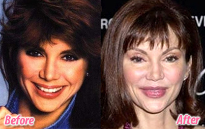 Image result for victoria principal before and after plastic surgery