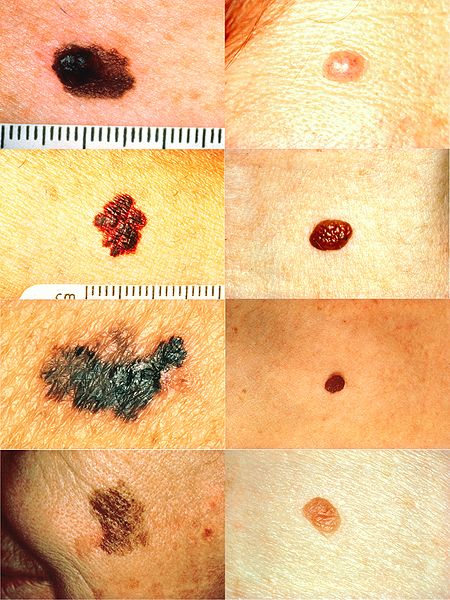 raised melanoma