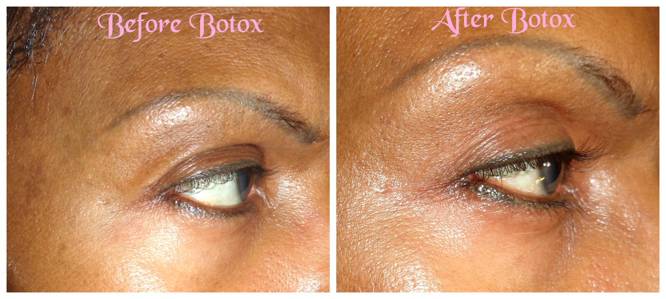 what causes droopy eyelids after botox