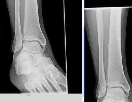 icd 10 lateral malleolus fracture