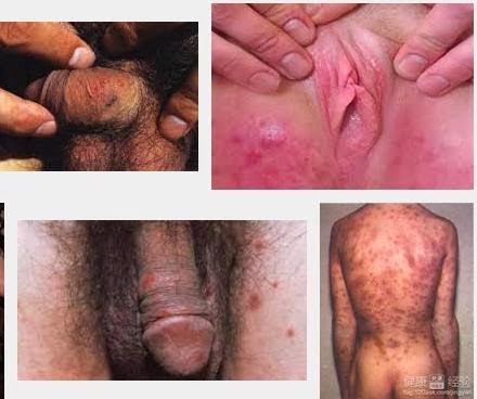 antibiotik untuk mengobati sifilis, obat sipilis, obat penyakit sipilis