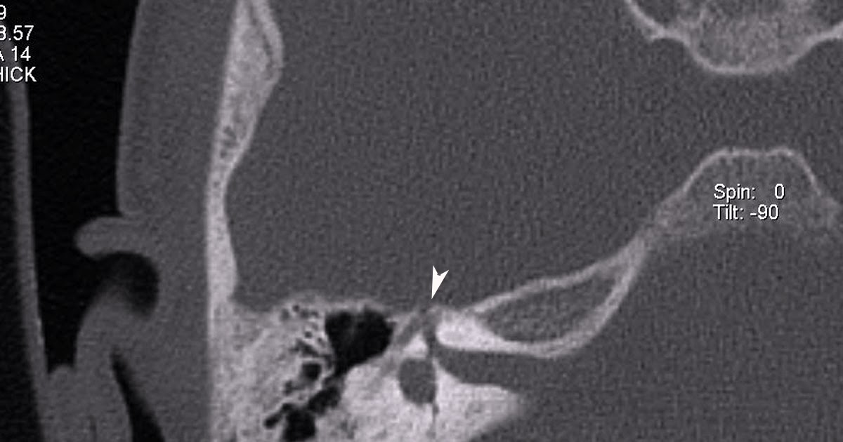 ct temporal bone facial nerve