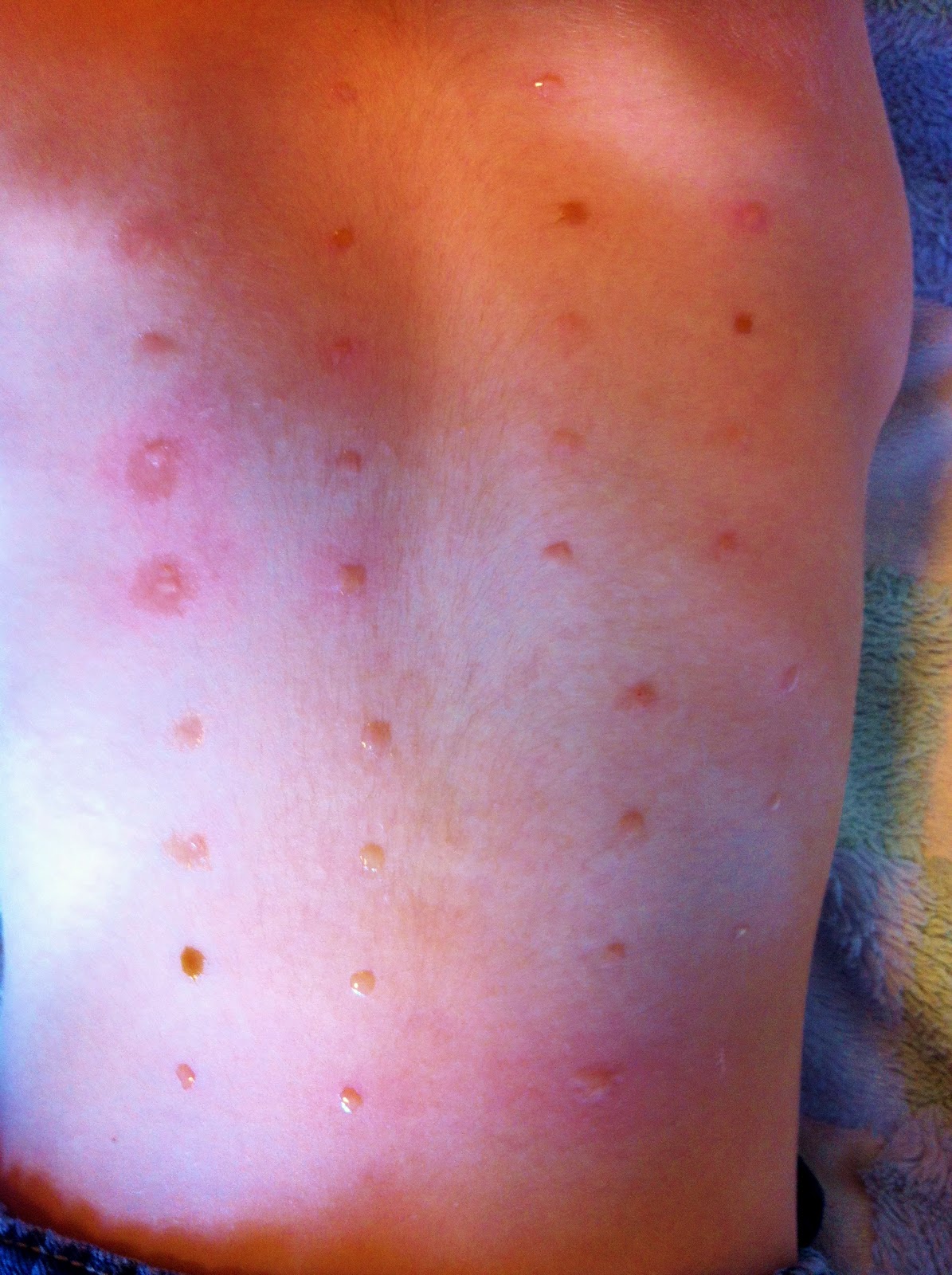 EoE First Allergy Appt After EoE Diagnosis EBL Food Allergies