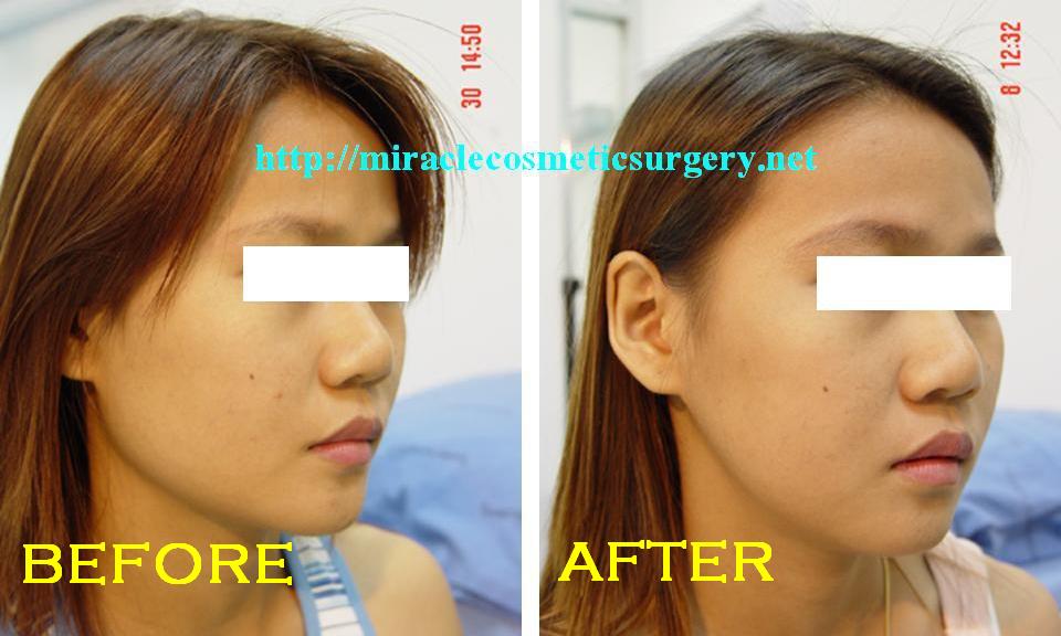 Plastic Surgery Photos Jaw Reduction Before And After Photos
