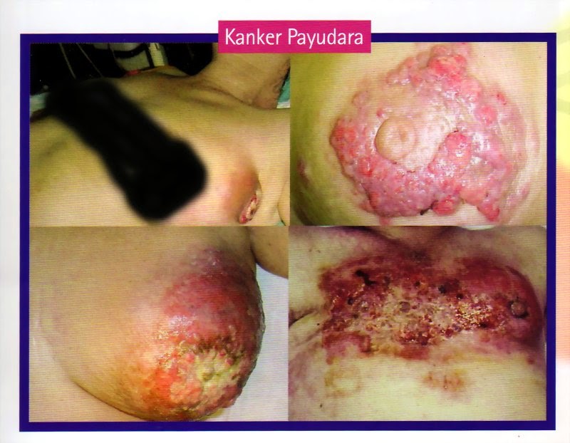 pengobatan tumor payudara alami, obat kanker otak, pengobatan kanker otak