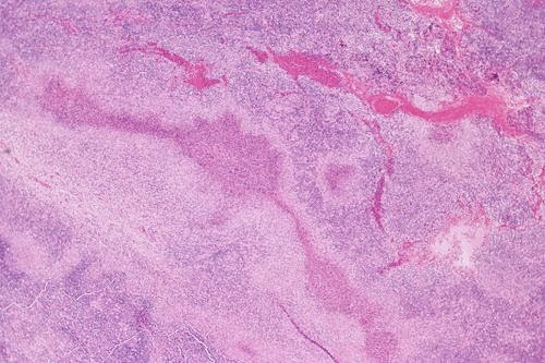 Psychology Of Medicine Cat Scratch Disease