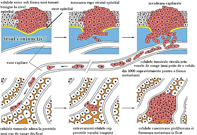 Formarea metastazelor la nivel hepatic