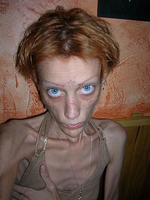 Extreme Anorexia
