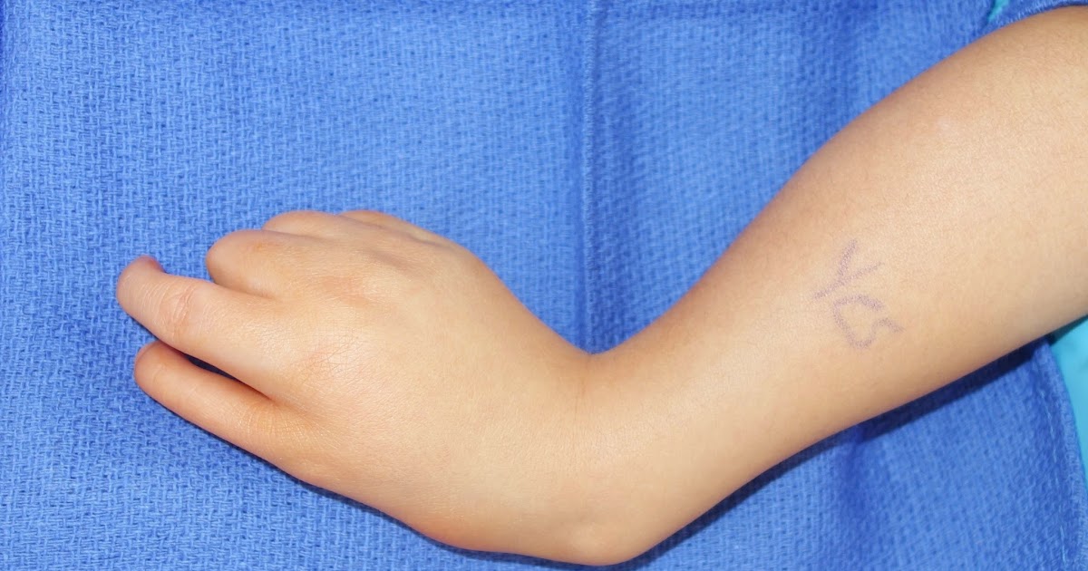 Wrist Deviation Congenital Hand and Arm Differences