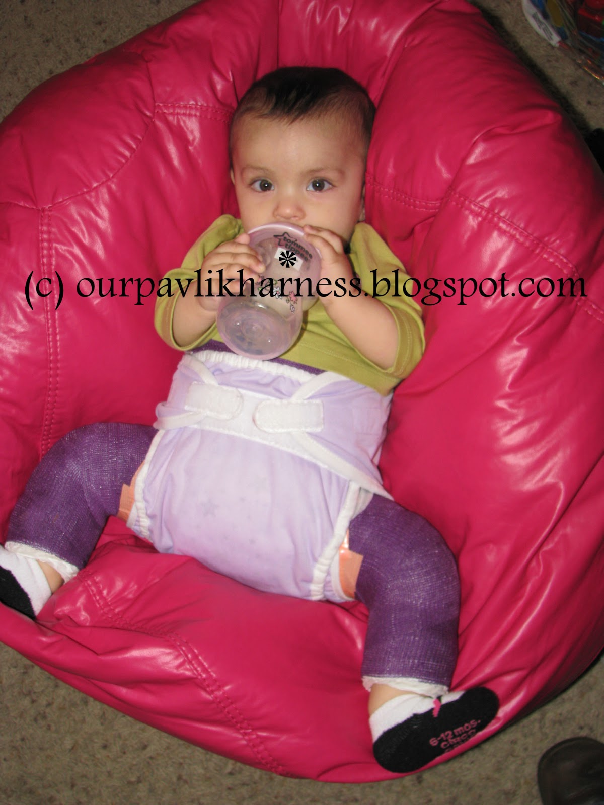 Our Pavlik Harness and journey with Hip Dysplasia Dressing the Spica baby