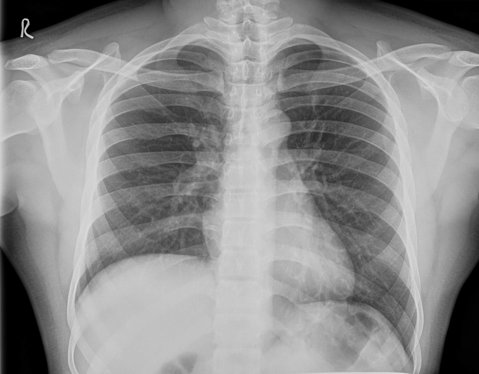 Elevated Dome of Diaphragm CXR Teaching Points Sumer's Radiology Blog