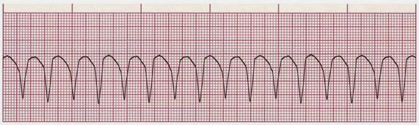 Kasus Gawat Darurat Ekg Abnormal