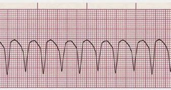 Kasus Gawat Darurat Ekg Abnormal