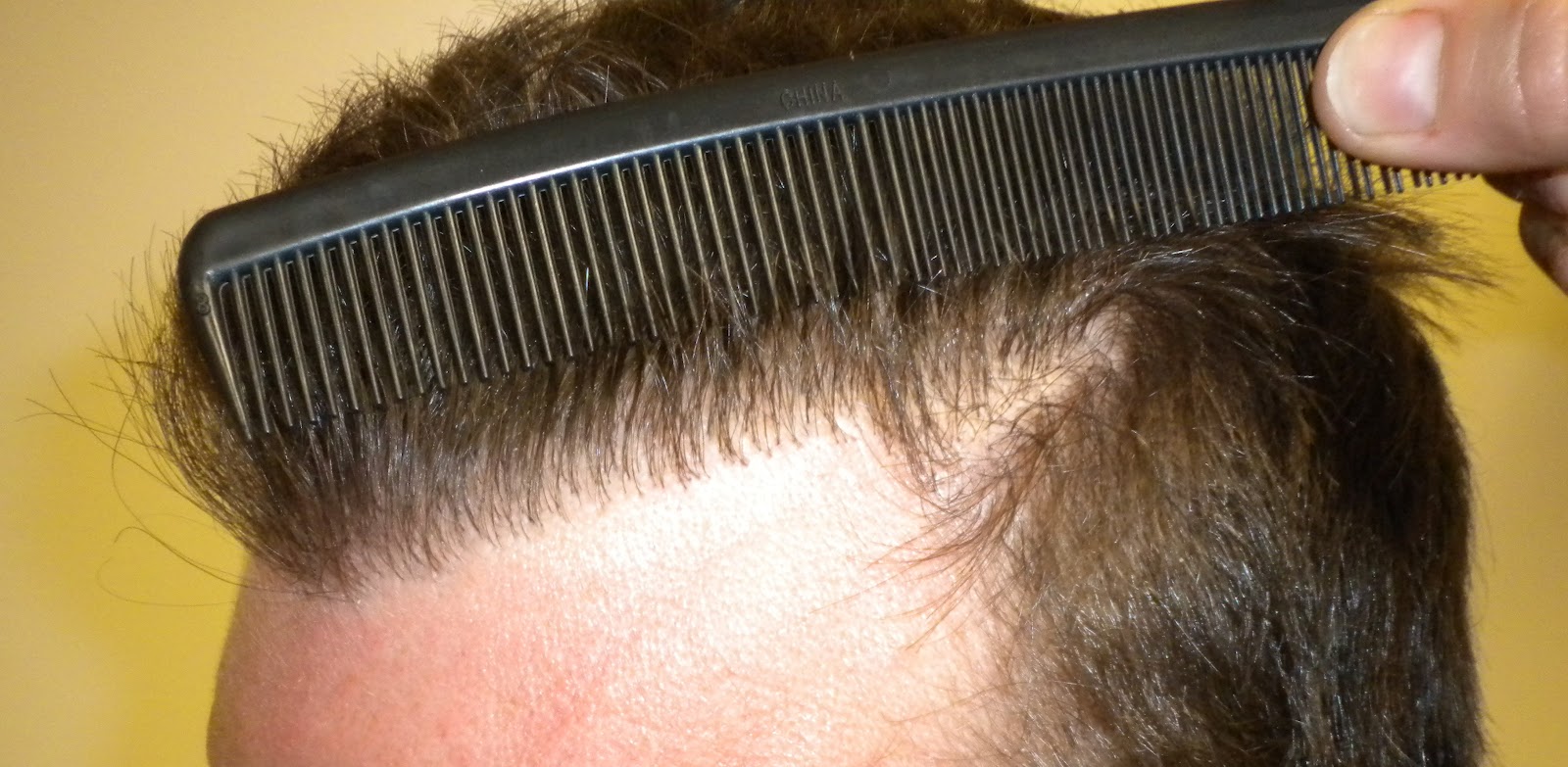 Patient Photos Hairline Techniques A Bad Hair Transplant vs. A Good Hair Transplant What