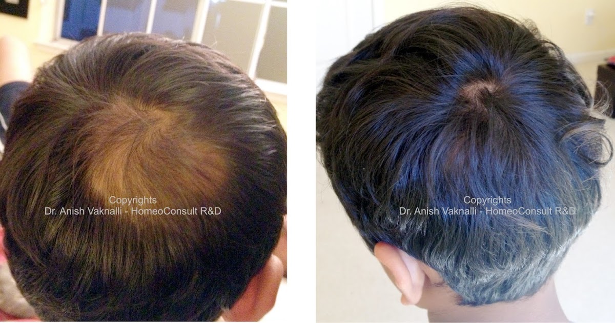HomeoConsult RD Hair Loss homeopathy doctor treatment, medicines