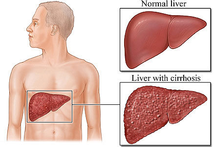 hepatitis b images