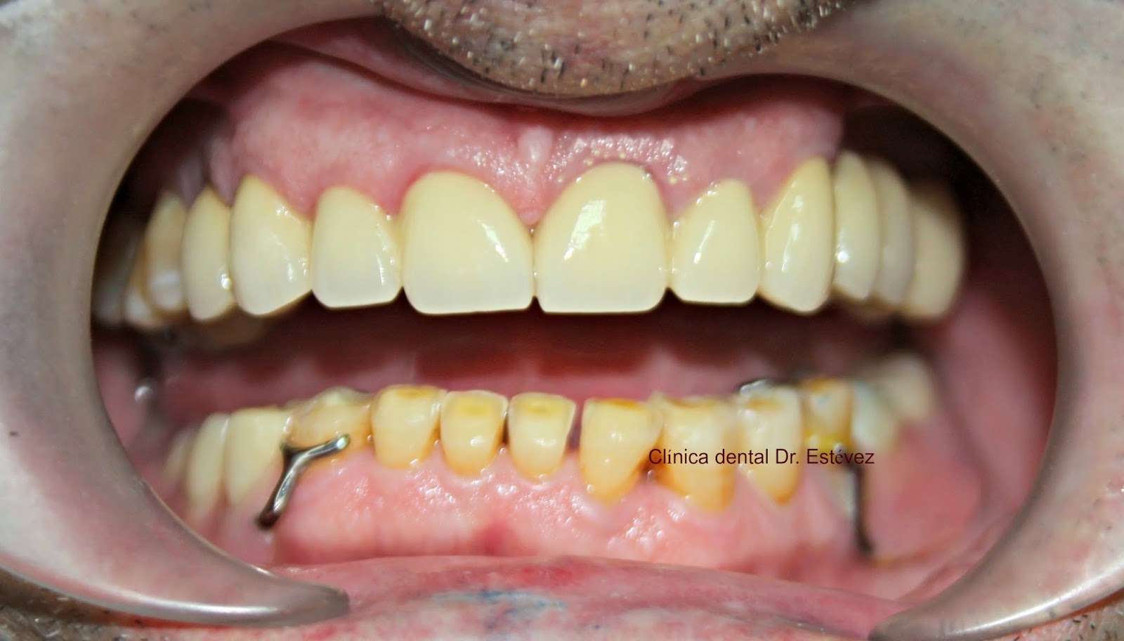 desgaste dental 