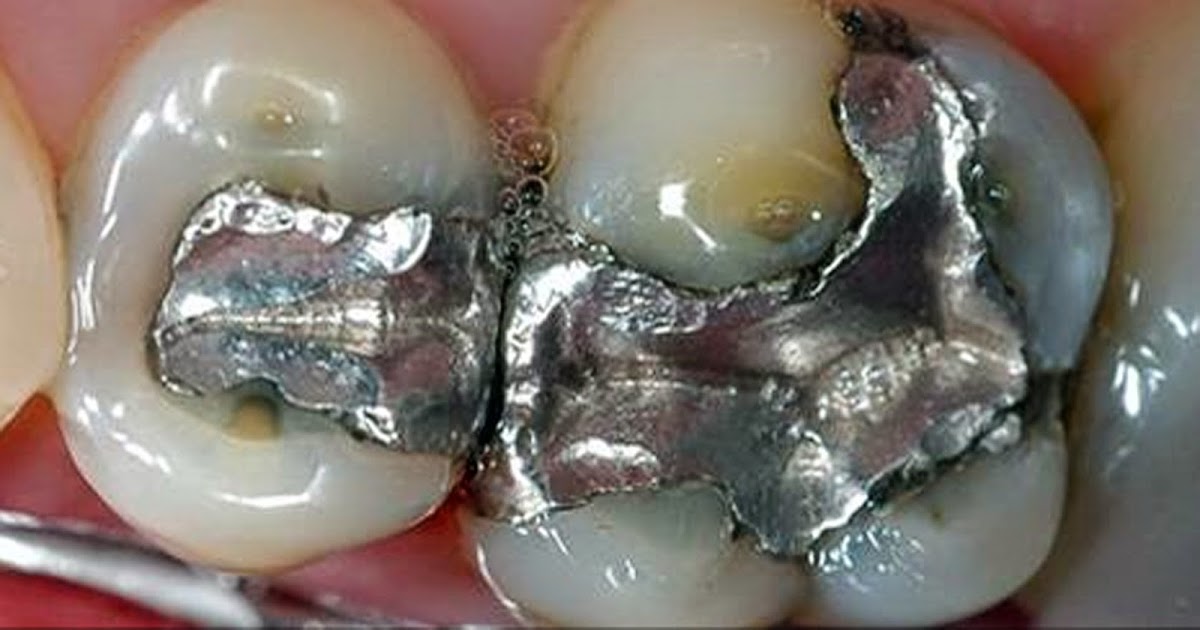 Killer In Your Mouth Remove Amalgam Fillings And You Will Be Healed Of