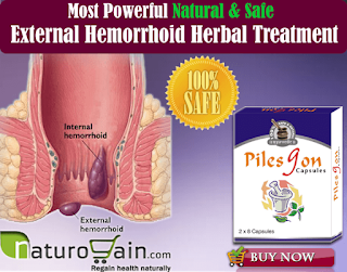 External Hemorrhoid Remedies