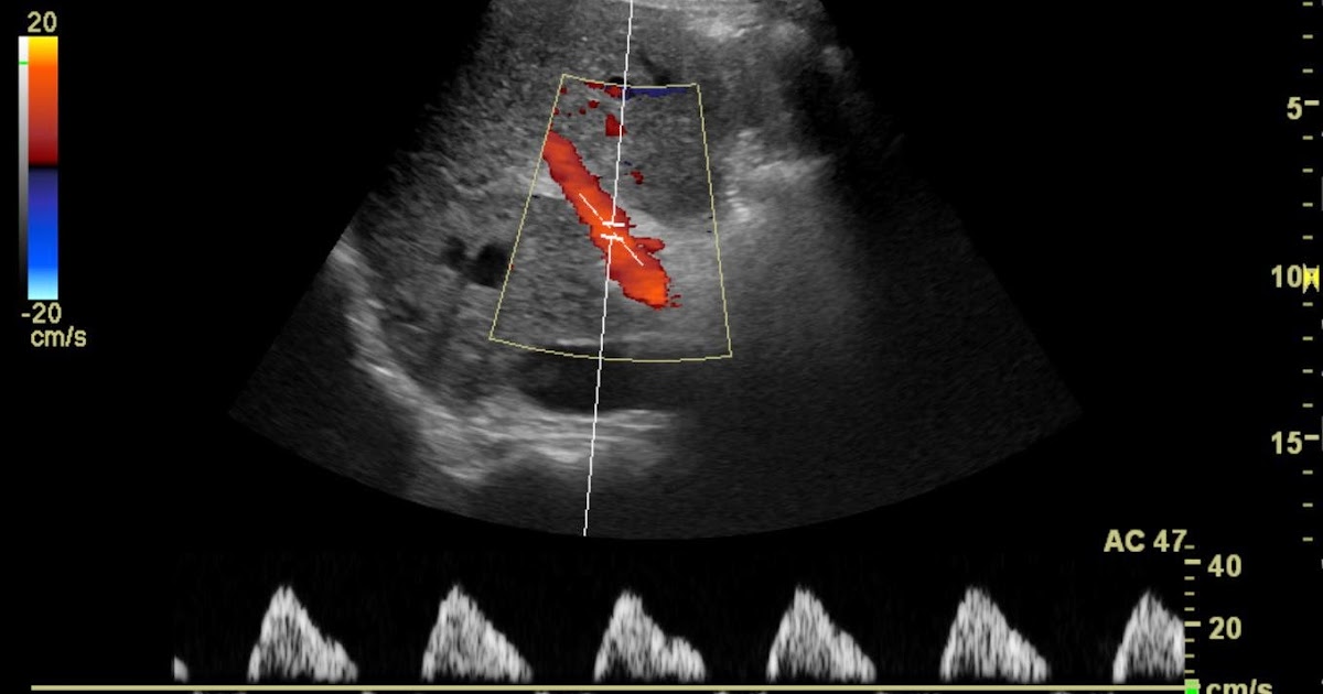 the xray doctor xrayoftheweek 2 what heart condition does this liver