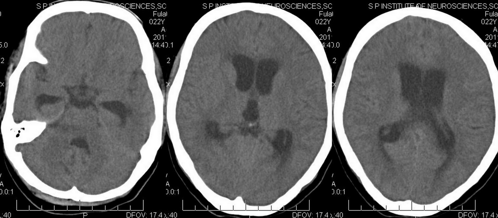 Dr Balaji Anvekar FRCR Hydrocephalus in Tubercular meningitis