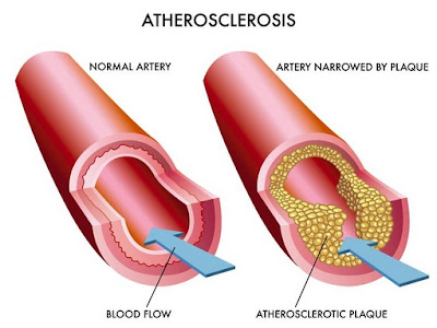aterosklerosis aterosklerosis